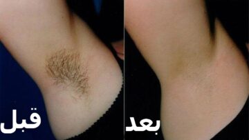 ارخص من الليزر.. بملعقة نشا وملح تخلصي من شعر العانة والجسم كله من الجذور وتبيض فوري للمناطق الحساسة