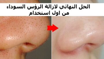 أنضف من الطبق الصيني…طريقة سهلة لازالة الرؤوس السوداء بشكل نهائي خلال 3 أيام