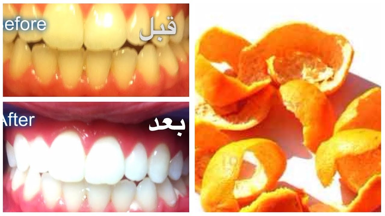 كيفية تحقيق ابتسامة أكثر بياضاً باستخدام قشور البرتقال لأسنان بيضاء كاللؤلؤء 5 كيفية تحقيق ابتسامة أكثر بياضاً باستخدام قشور البرتقال لأسنان بيضاء كاللؤلؤء