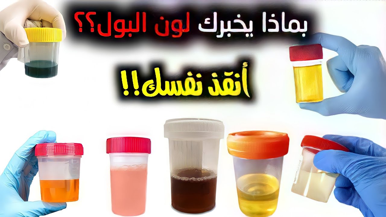 لون البول قد يشير أنك تعانى من مرض خطير تعرف عليه قبل فوات الأوان 5 لون البول قد يشير أنك تعانى من مرض خطير تعرف عليه قبل فوات الأوان