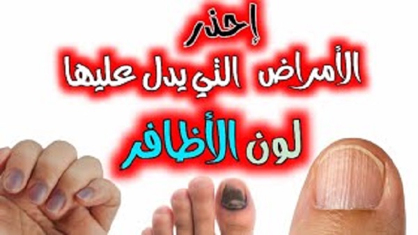 أحذر ظهور هذه الألوان على أظافرك فهي تنذر بوجود مشاكل صحية كبيرة 5 أحذر ظهور هذه الألوان على أظافرك فهي تنذر بوجود مشاكل صحية كبيرة