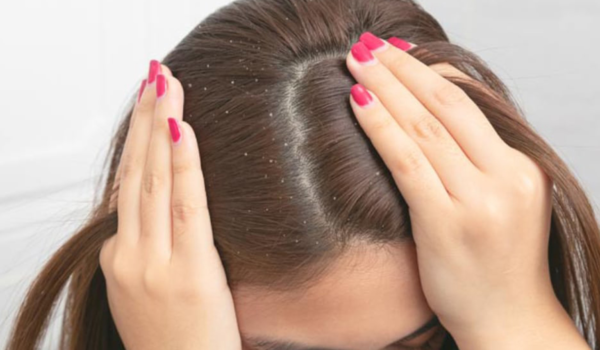 5 علاجات منزلية للتخلص من قشرة الشعر ولمعناه في وقت قصير 5 5 علاجات منزلية للتخلص من قشرة الشعر ولمعناه في وقت قصير