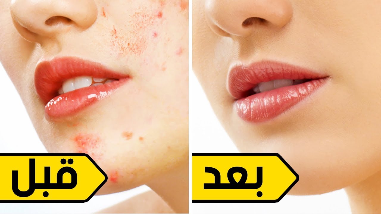 3 وصفات لإزالة حب الشباب من الوجه نهائياً