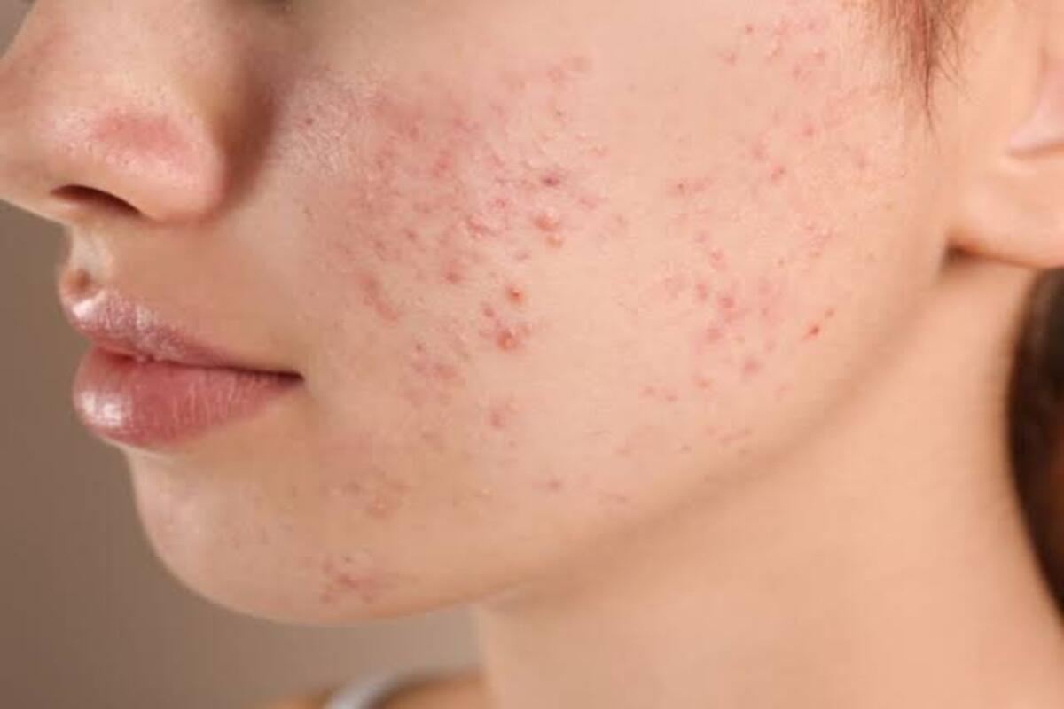 لبشرة صافية وناعمة…طرق التخلص من الحبوب تحت الجلد بمكونات متواجدة في كل منزل