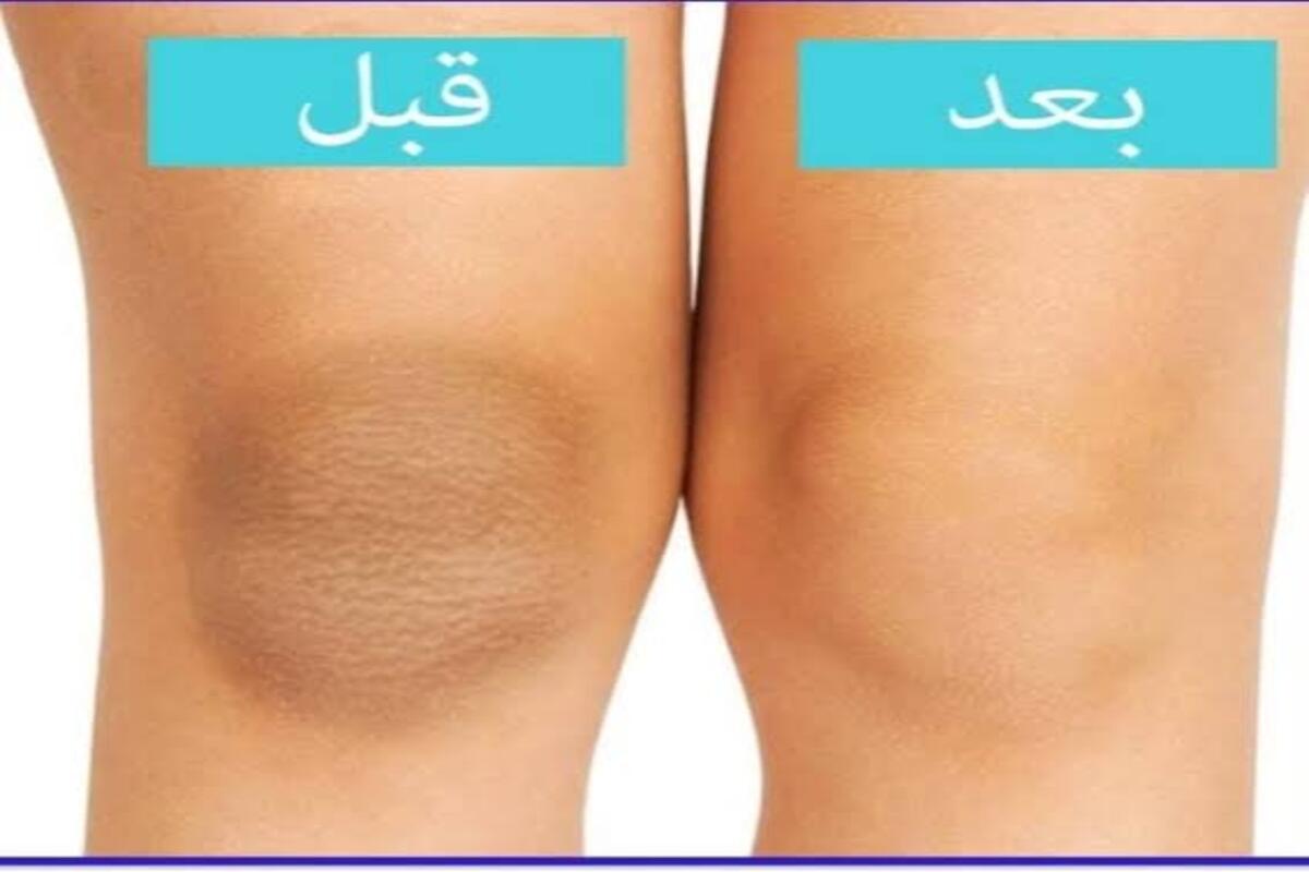 النتيجة رائعة … وصفة تبييض الركبتين مضمونة ومجربة متحسيش بالإحراج تاني 5 النتيجة رائعة … وصفة تبييض الركبتين مضمونة ومجربة متحسيش بالإحراج تاني