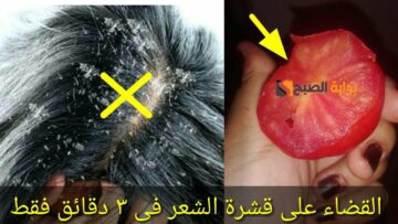 متقوليش لعدوك عليها.. وصفة جهنمية لإزالة القشرة المدارية كلمة السر “خل التفاح” هتشكريني عليها طول عمرك
