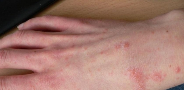 بـ 3 طرق.. كيفية علاج حساسية بق الفراش وما هي علاماتها 5 بـ 3 طرق.. كيفية علاج حساسية بق الفراش وما هي علاماتها