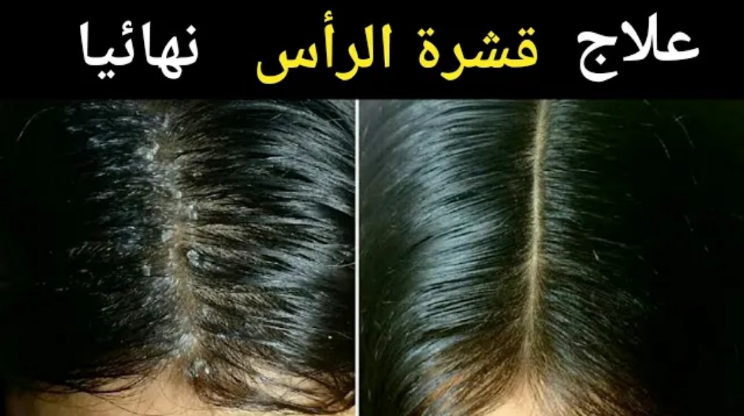 بمكون لا يخطر على بالك موجود في منزلك يقضي تماما على قشرة الشعر 5 بمكون لا يخطر على بالك موجود في منزلك يقضي تماما على قشرة الشعر
