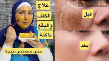 المشكلة أن حلاوتك هتبقى بزيادة.. كريم بمكونات منزلية هيحل كل مشاكل بشرتك ويخليكي كأنك لسه عروسة