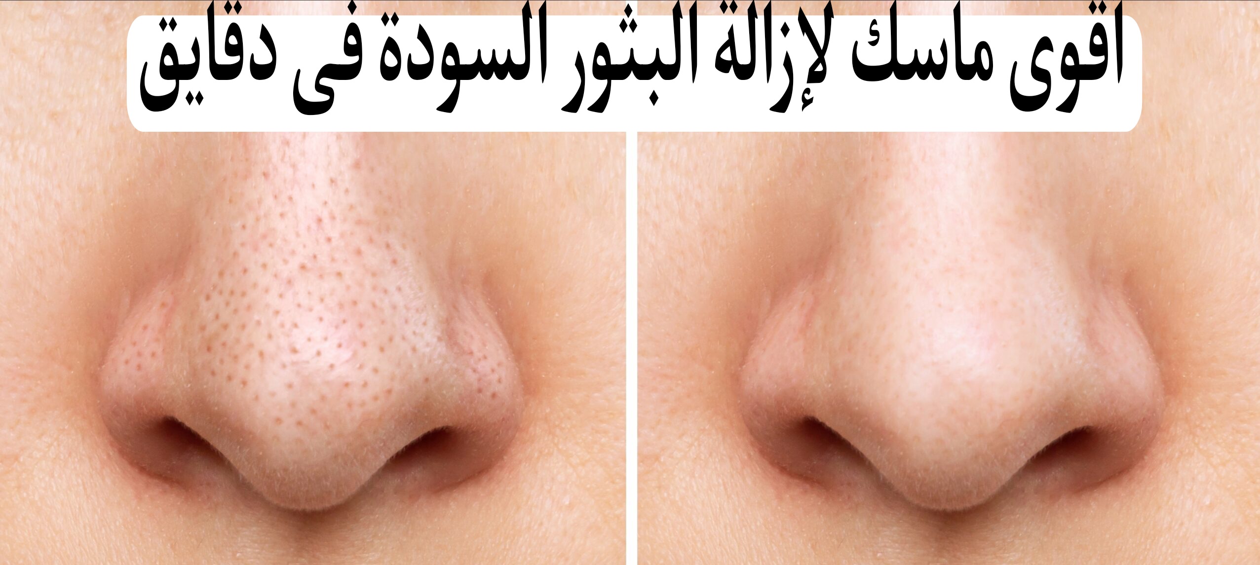 مش هتصدقي إنك اتخلصتي منها بسهولة كده...أقوى ماسك لإزالة البثور السودة بدون تكلفة نهائي 5 مش هتصدقي إنك اتخلصتي منها بسهولة كده…أقوى ماسك لإزالة البثور السودة بدون تكلفة نهائي