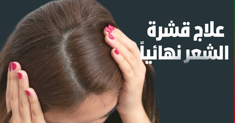 “وفر فلوس الشامبو“ كيفية التخلص من قشرة الشعر في المنزل بأسهل طريقة 5 “وفر فلوس الشامبو“ كيفية التخلص من قشرة الشعر في المنزل بأسهل طريقة