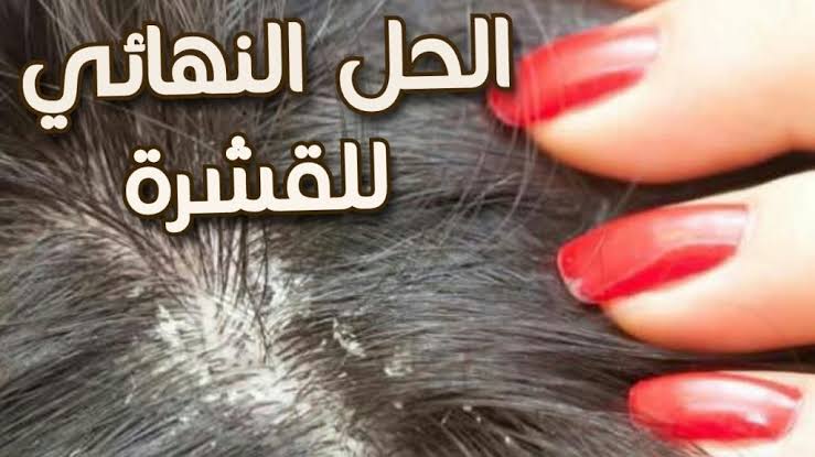 خلطة سحرية للتخلص من قشرة الشعر في أسرع وقت 6 خلطة سحرية للتخلص من قشرة الشعر في أسرع وقت