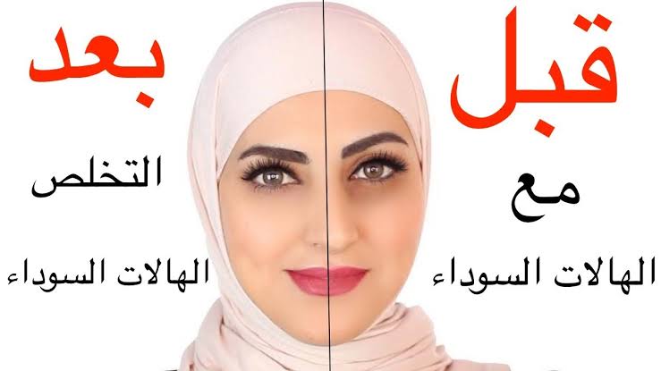 هترجعي نص جمالك.. وصفات سحرية للتخلص من الهالات السوداء حول العين تماماً 5 هترجعي نص جمالك.. وصفات سحرية للتخلص من الهالات السوداء حول العين تماماً