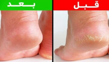 هيزحلق من كتر النعومة.. طريقة سحرية لتقشير الكعبين والتخلص من التشققات في ثواني
