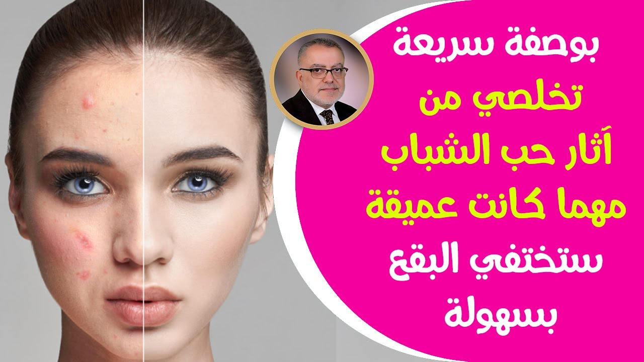 تفتيح البشرة وإزالة الحبوب بكل سهولة بوصفات طبيعية وآمنة 5 تفتيح البشرة وإزالة الحبوب بكل سهولة بوصفات طبيعية وآمنة