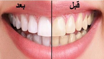 “بديل لجلسات التنظيف” طريقة تبييض الأسنان والقضاء علي الاصفرار