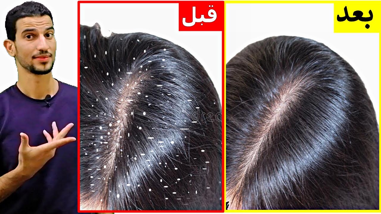 “وداعا للإحراج” طريقة علاج قشرة الشعر نهائيا والاستمتاع بشعر لامع وصحي