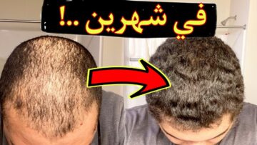 الكل هينبهر بطوله.. ” محلول منزلي ينبت فراغات الشعر مفعوله سريع هتودعي الصلع وكل مشاكل الشعر للأبد