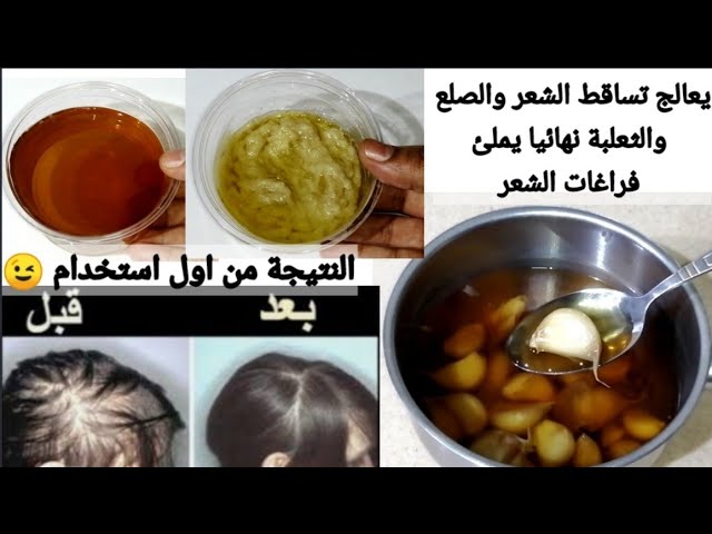 لن تعاني من تساقط الشعر بعد اليوم بخلطة الثوم والقرنفل ضعيها علي فراغات شعرك تعالج الصلع الثعلبة 5 لن تعاني من تساقط الشعر بعد اليوم بخلطة الثوم والقرنفل ضعيها علي فراغات شعرك تعالج الصلع الثعلبة