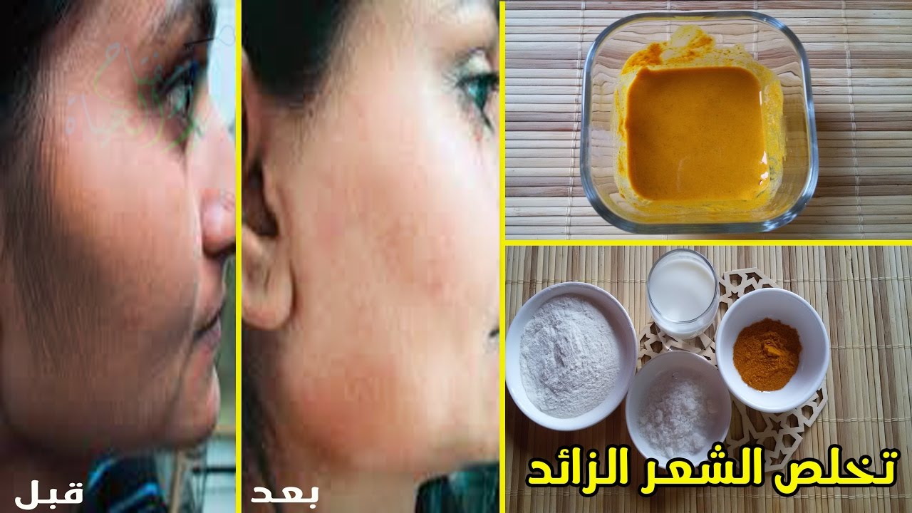 مش هتحتاجي الليزر تاني… وصفة النشا والكركم للتخلص من الشعر الزايد في غمضة عين