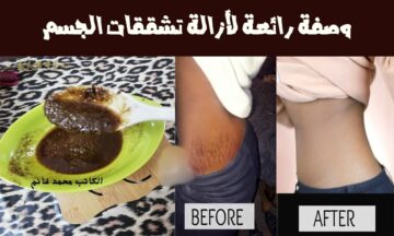 هتزغللي عيون زوجك.. خليط من القهوة وزيت الزيتون الحل السحري للتخلص من علامات تمدد الجلد “وفري فلوس الجلسات”