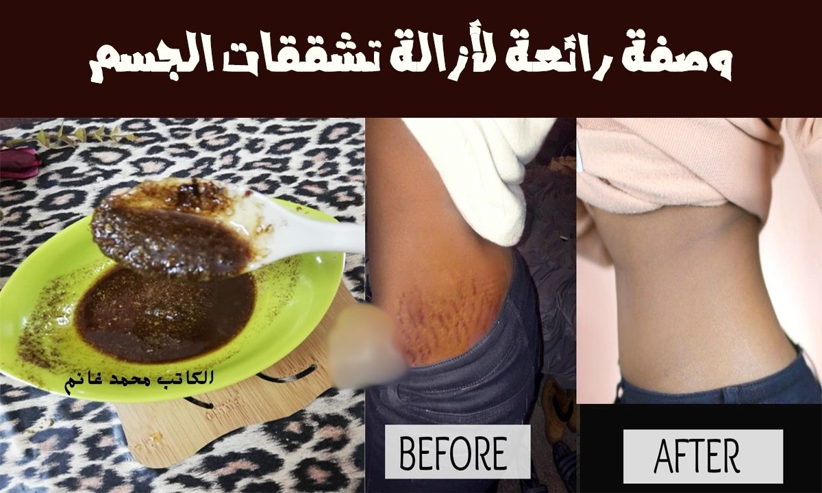 هتزغللي عيون زوجك.. خليط من القهوة وزيت الزيتون الحل السحري للتخلص من علامات تمدد الجلد “وفري فلوس الجلسات”