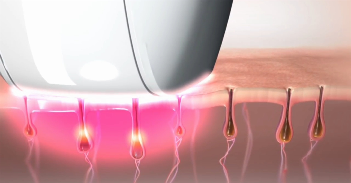 طريقة إزالة الشعر في المنزل بمكونات طبيعية مضمونة 5 طريقة إزالة الشعر في المنزل بمكونات طبيعية مضمونة