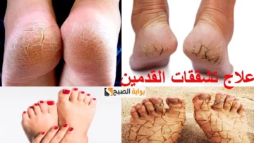 مقشر الملح مع الفازلين والترمس لإزالة تشققات القدمين والجلد في فصل الشتاء “رجلك هتبقى زي البلور”