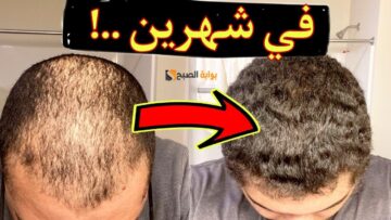 لأصحاب الشعر الخفيف.. وصفة ممتازة ومجربة من الشاي الأخضر والأبيض لزيادة كثافة الشعر وإنبات الفراغات