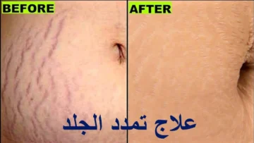 زغللي عيون جوزك..” فنجان قهوة سر التخلص من خطوط الجسم البيضاء والحمراء في غمضة عين هتشوفي حلاوتك