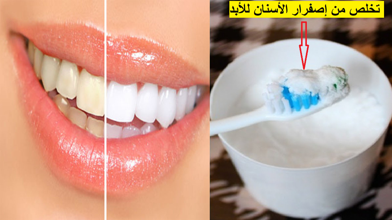 وصفة للتخلص من اصفرار الأسنان والجير نهائيا في المنزل بطرق طبيعية وإعادة الابتسام البيضاء