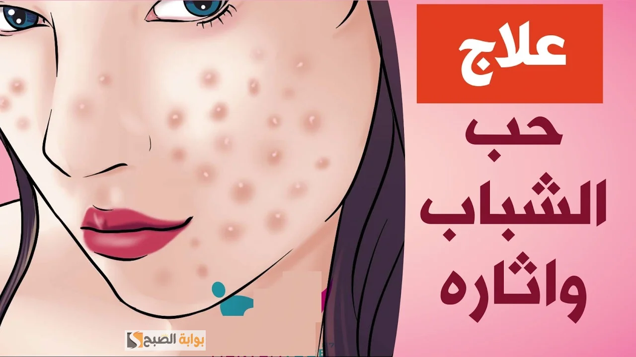 العشبة الخضراء المعجزة لإزالة البثور وعلاج ندبات حب الشباب "بشرتك هتبقى صافية وزي البدر" 5 العشبة الخضراء المعجزة لإزالة البثور وعلاج ندبات حب الشباب “بشرتك هتبقى صافية وزي البدر”