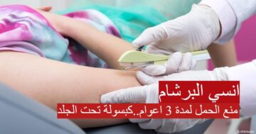 “امنعي بمزاجك”.. منع الحمل لمدة 3 اعوام عن طريق كبسولة تحت الجلد