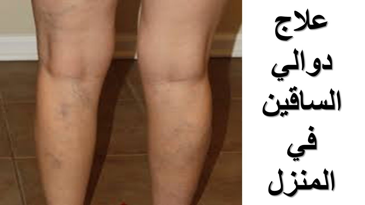امرأة عجوز وصفت لي هذه الوصفة بحبة طماطم واحدة قضت علي الدوالي ولم يعد لها اثر