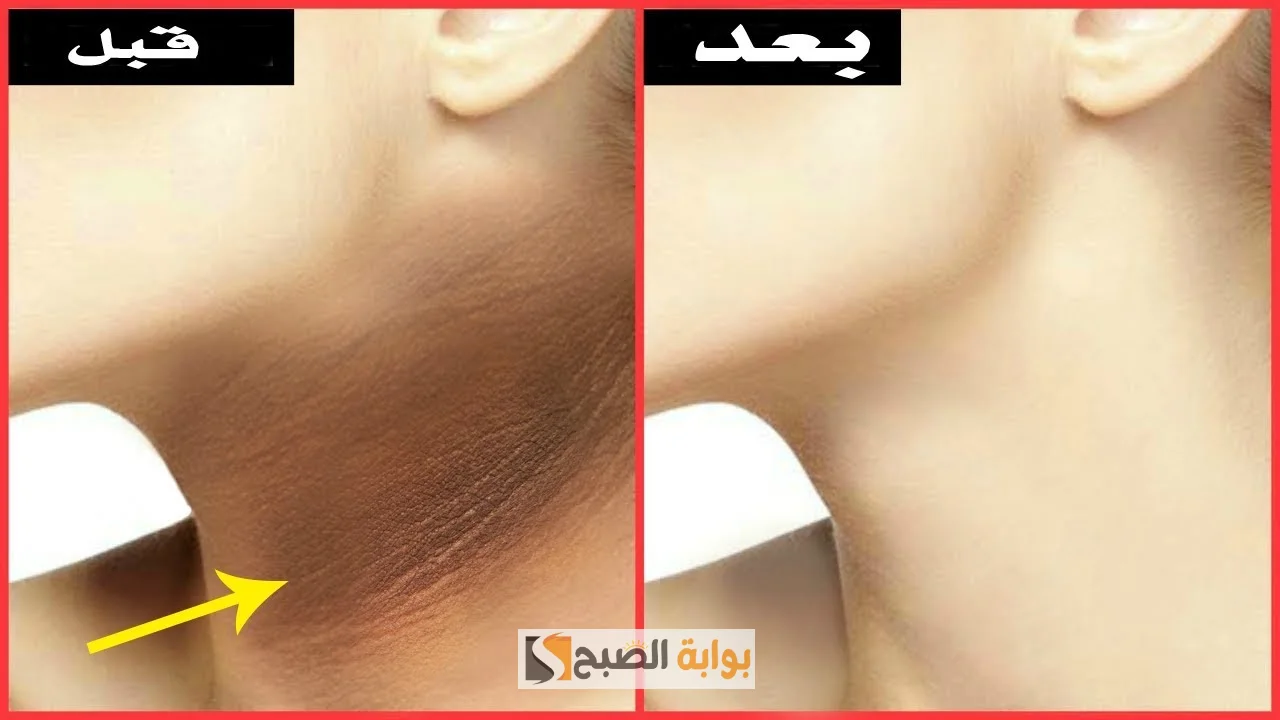 وصفة عصير البرتقال والنشا لتفتيح الرقبة وإزالة الاسمرار “هتبقى زي القشطة”