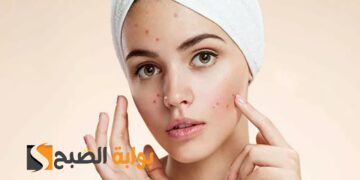 لبشرة صافية أفضل وصفة لإزالة الحبوب من الوجه في يوم واحد والتخلص من البثور