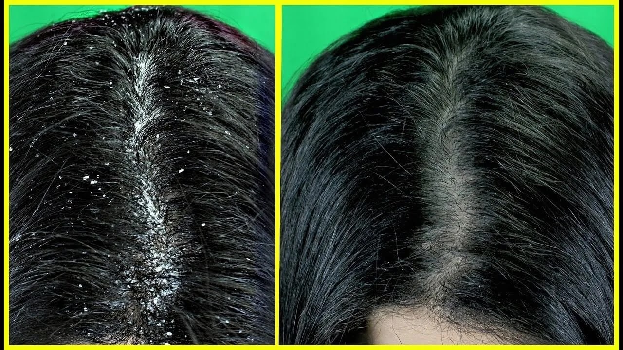 هاتي كوب خل تفاح وتعالي أقولك أزاي تتخلصي من قشرة الشعر في ساعة واحدة بس 5 هاتي كوب خل تفاح وتعالي أقولك أزاي تتخلصي من قشرة الشعر في ساعة واحدة بس