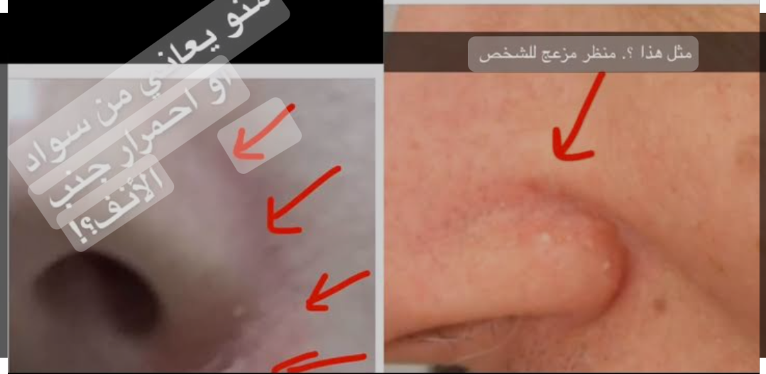 بدون كريمات ولا كوافير.. طرق طبيعية لإزالة الإسمرار حول الأنف 5 بدون كريمات ولا كوافير.. طرق طبيعية لإزالة الإسمرار حول الأنف