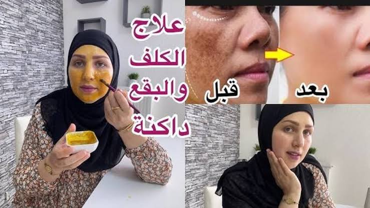ماسك طبيعي لإزالة الكلف والبقع الداكنة بنتائج مذهلة 5 ماسك طبيعي لإزالة الكلف والبقع الداكنة بنتائج مذهلة