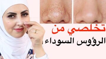 جمالك هيزيد.. حل سحري للتخلص من الرؤوس السوداء بفاعلية كبيرة