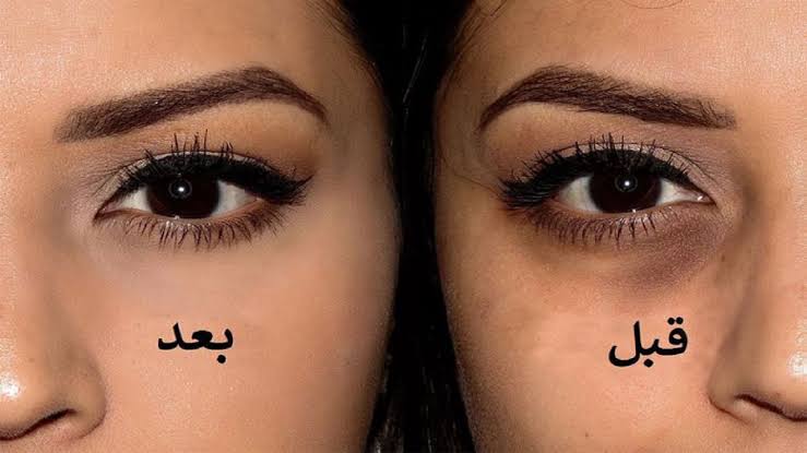 خلي عيونك ترجع تنور.. وصفة طبيعية لعلاج الهالات السوداء وإعادة بشرتك إلى رونقها 5 خلي عيونك ترجع تنور.. وصفة طبيعية لعلاج الهالات السوداء وإعادة بشرتك إلى رونقها