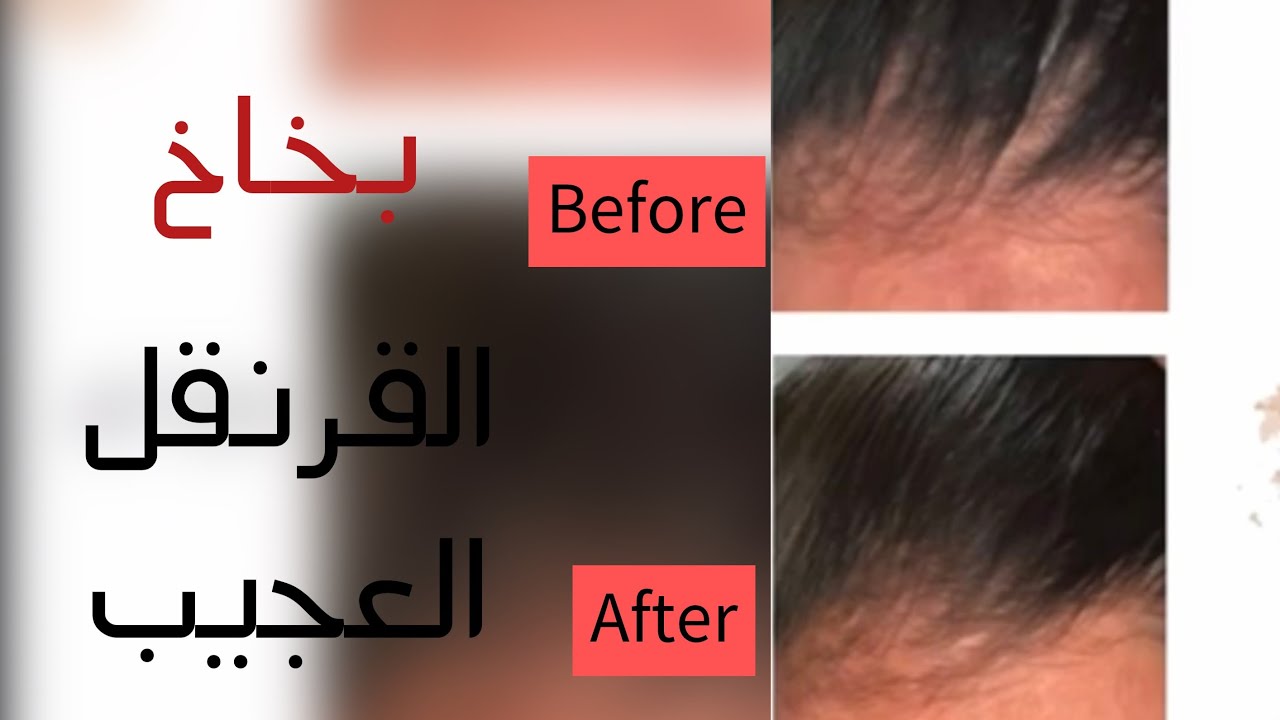 بخاخ القرنفل الرهيب لتكثيف الشعر وإنبات الفراغات ومقدمة الرأس بسرعة الصاروخ 5 بخاخ القرنفل الرهيب لتكثيف الشعر وإنبات الفراغات ومقدمة الرأس بسرعة الصاروخ