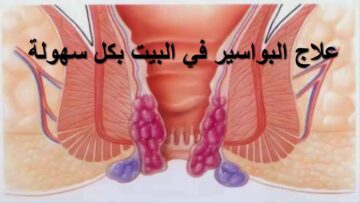 علاج البواسير في المنزل بمكونات طبعيه دون أي اثار جانبية