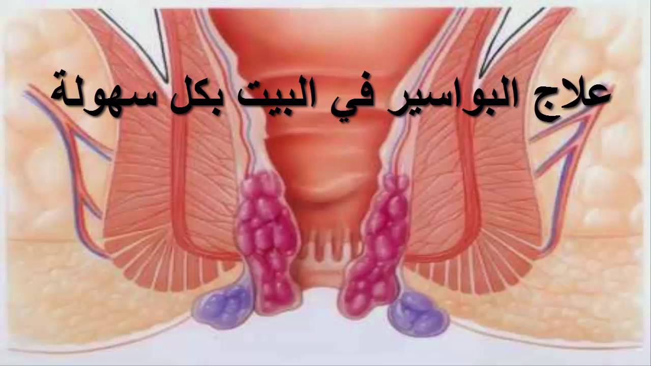 علاج البواسير في المنزل بمكونات طبعيه دون أي اثار جانبية