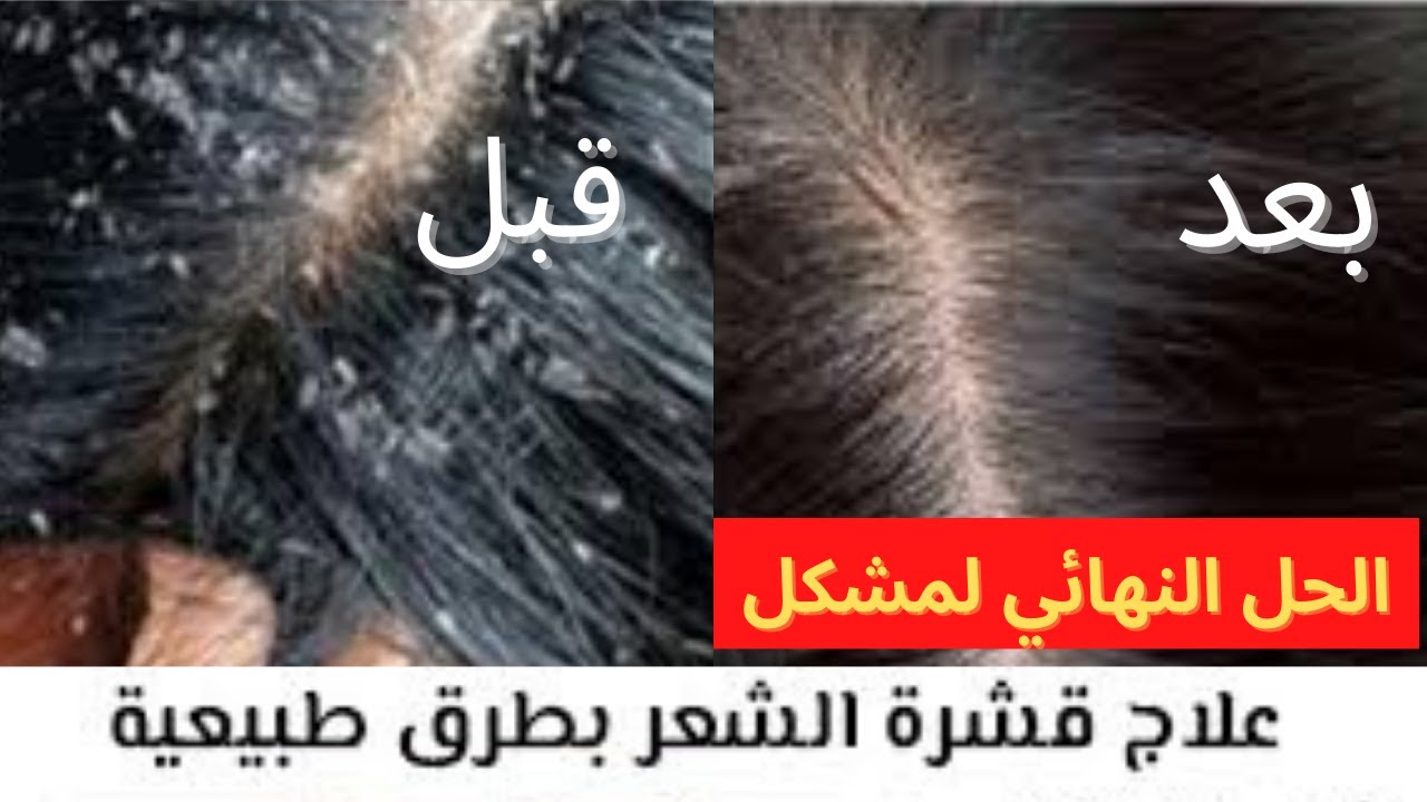 كيف تتخلص من القشرة في الشعر نهائياً بطريقة طبيعية 5 كيف تتخلص من القشرة في الشعر نهائياً بطريقة طبيعية