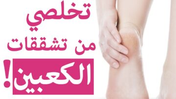 علاج تشقق القدمين وجفاف الجلد بأربع مكونات فقط