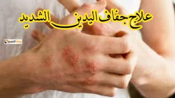 وصفات سهلة وغير مكلفة.. الحل النهائي لمشكلة جفاف اليدين في فصل الشتاء