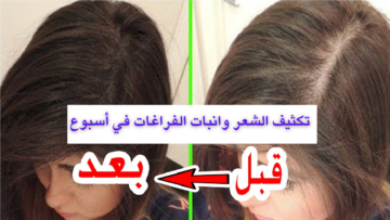 أسرع خلطة طبيعية لتكثيف الشعر الخفيف وإنبات فراغات مقدمة الرأس