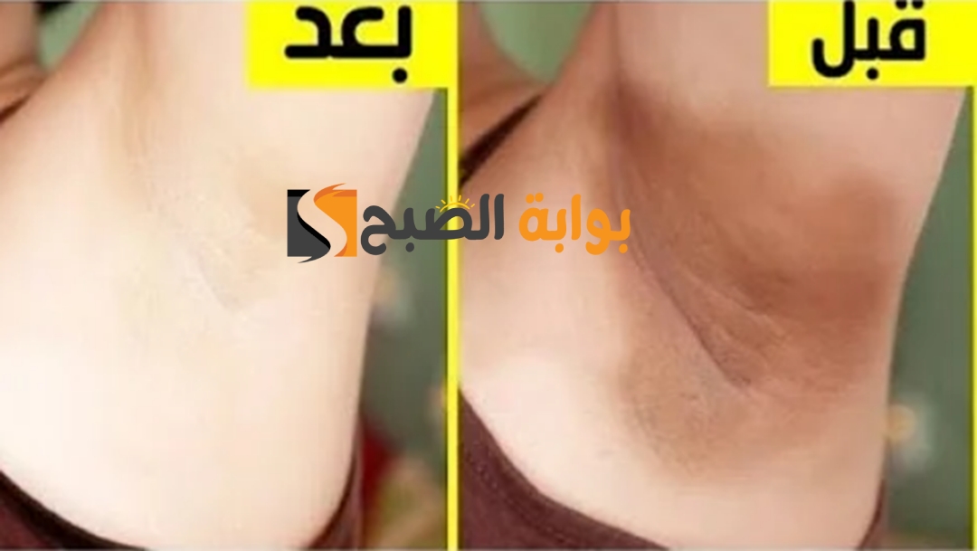 تخلصي من سواد 20 سنة وصفة لتبييض المناطق الحساسة من اول استعمال حتى لو كانت زي الفحم 5 تخلصي من سواد 20 سنة وصفة لتبييض المناطق الحساسة من اول استعمال حتى لو كانت زي الفحم