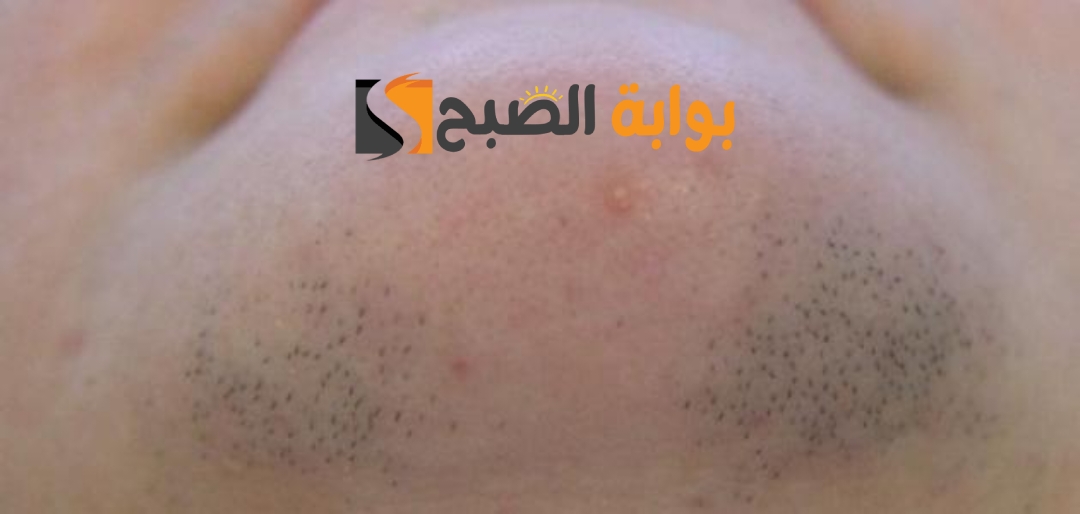 وصفة فعالة لإزالة الشعر الزائد من جذوره دون ألم حل نهائي "للعانة وشعر الوجه والجسم بأكمله" 5 وصفة فعالة لإزالة الشعر الزائد من جذوره دون ألم حل نهائي “للعانة وشعر الوجه والجسم بأكمله”
